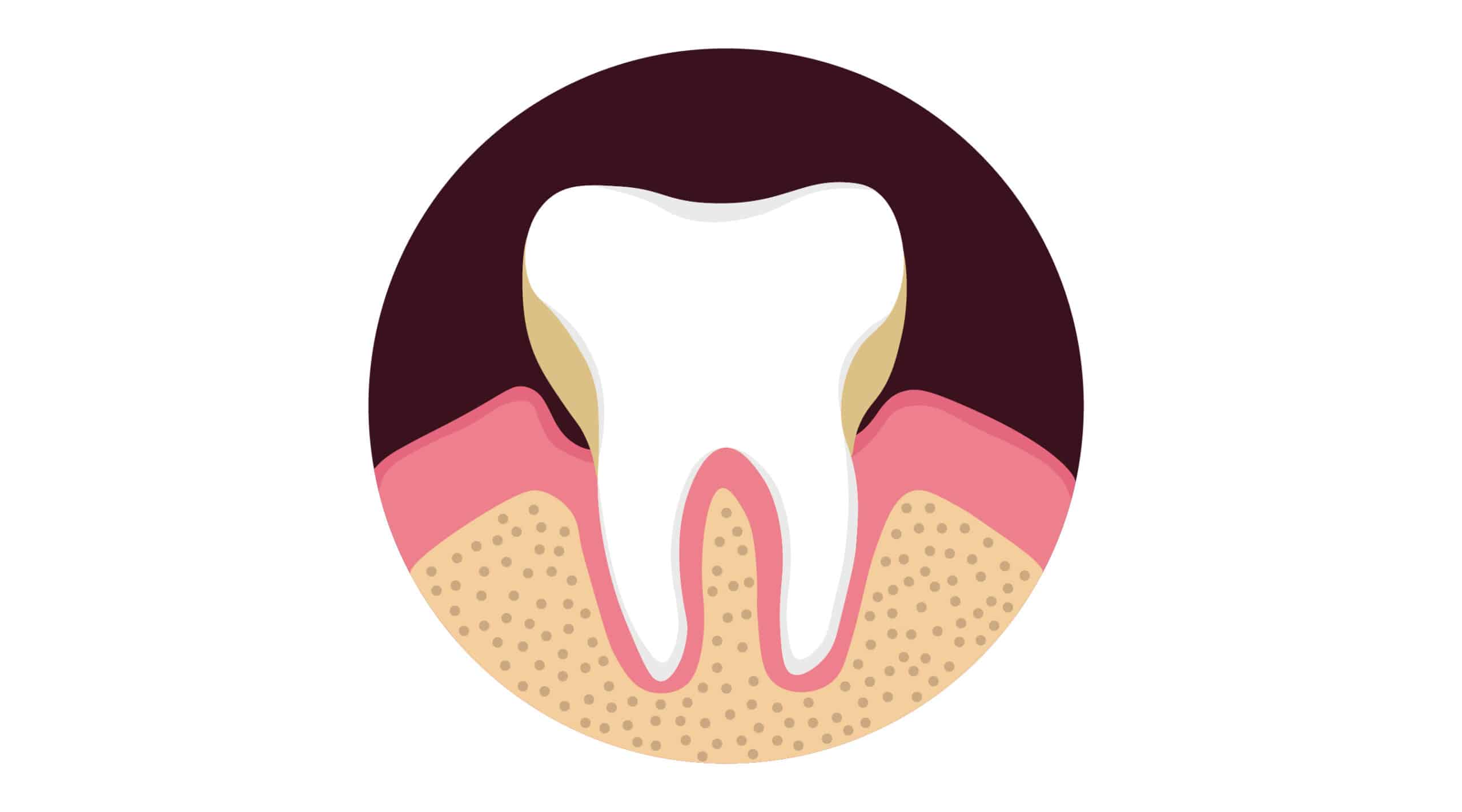 Are You At Risk For Gum Disease? How To Tell And What To Do Now.