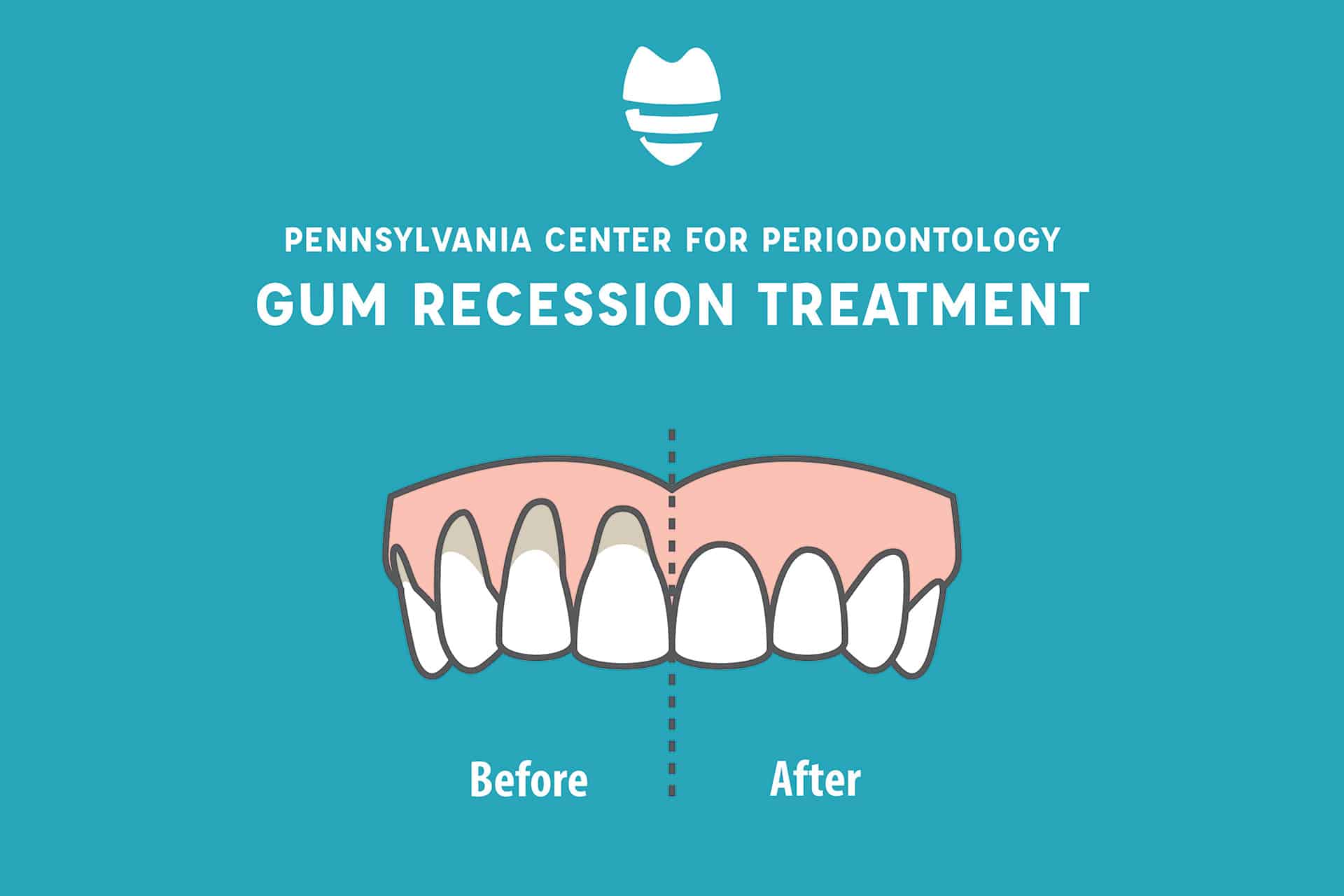 treatment-of-gum-recession-periodontist-in-enola-camp-hill-area