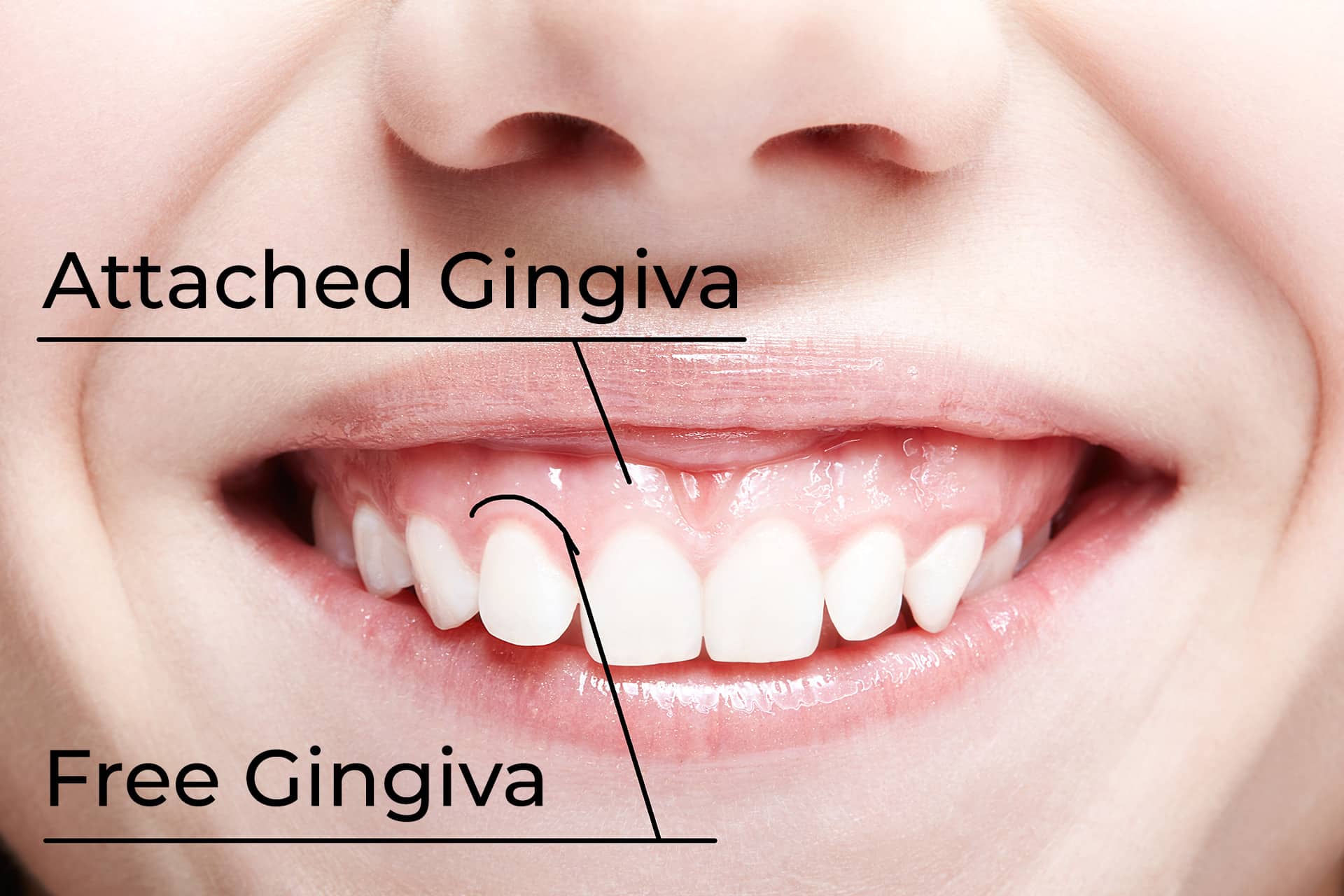 Periodontal Pocket After Wisdom Teeth Removal